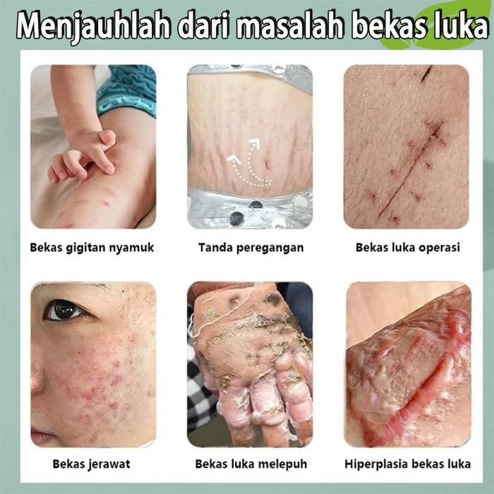 COD-Promo khusus scar cream penghilang luka berbekas salep keloid paling ampuh bekas luka bekasluka