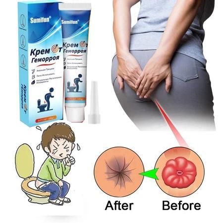 Obat Wasir/Obat Ambeien Salep Ambeien Paling Ampuh Salep Ambeien/Obat Ambeien Paling Ampuh/Mengobati