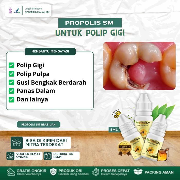 PROMO PROPOLIS SM SOLUSI UNTUK MENGATASI POLIP GIGI, PENGHILANG DAGING DI LUBANG GIGI, POLIP PULPA,
