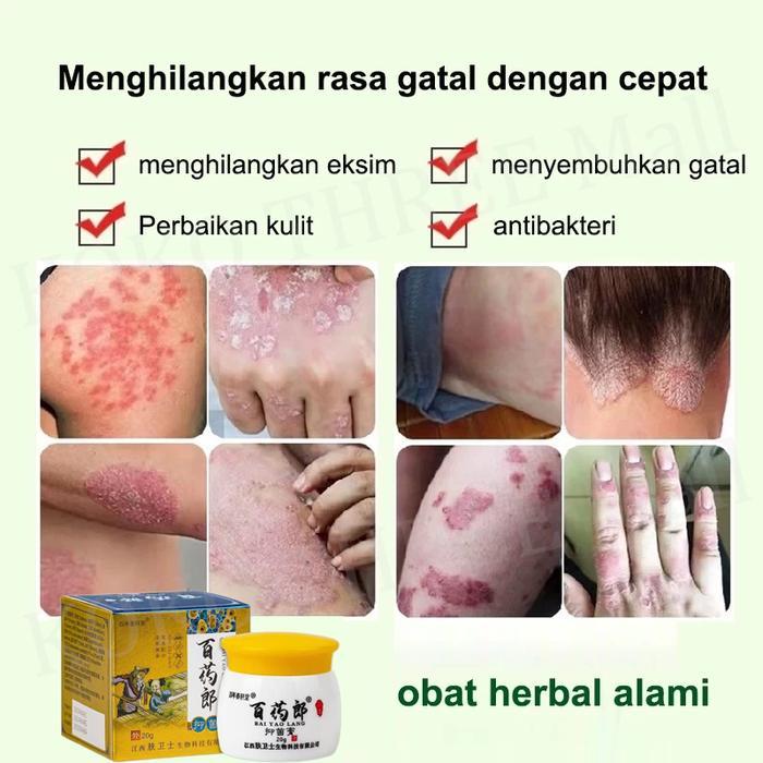 Salep Gatal China Paling Ampuh Salep Gatal Jamur Selangkanga Krim Eksim Bayi Dan Anak Obat Gatal