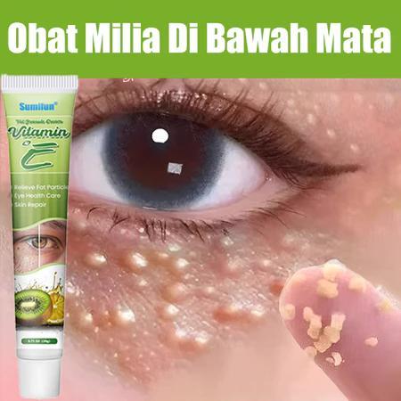 krim Penghilang Milia 20g vitamin serum milia di bawah mata ampuh milia remover penghilang milia