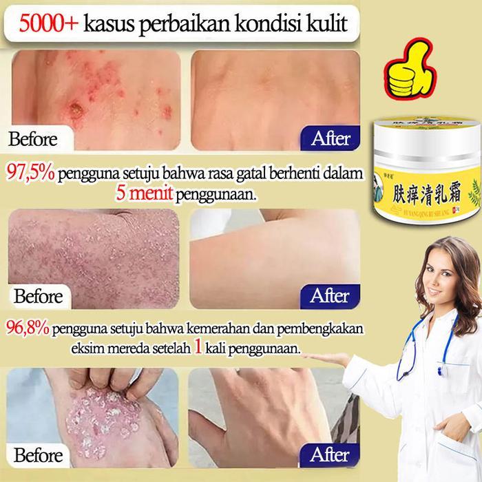 Salep Cina Gatal Paling Ampuh Original Salep Eksim Kering Dan Gatal Obt Gatal Seluruh Badan Obat