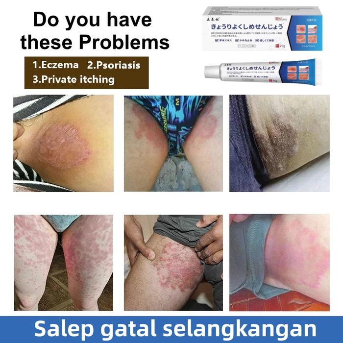 Salep Gatal Selangkangan Saleb Gatal Paling Ampuh Menghilangkan Eksim Dan Kurap Anti Jamur Tbk