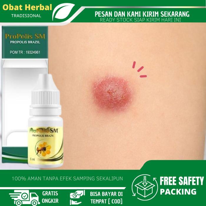 Salep Bisul Biar Gak Tumbuh Lagi, Bisul Untuk Anak, Bisul Di Pantat, Bisuk Di Ketiak, Bisul Di