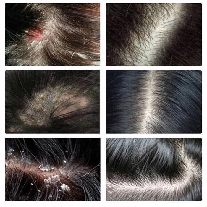 OBAT KETOMBE PARAH Scalp Itching Anti itching cream Obat Psoriasis di Kepala Eksim Kulit kepala