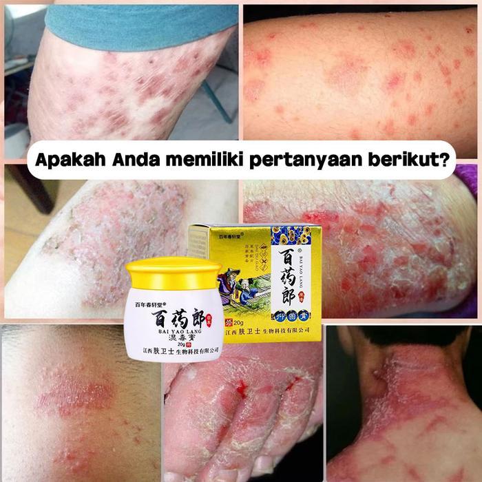 Salep Exim Gatal Eksim Paling Ampuh Salap Kurap 0bat Gatal Di Selangkangan Badan Meredakan Gatal