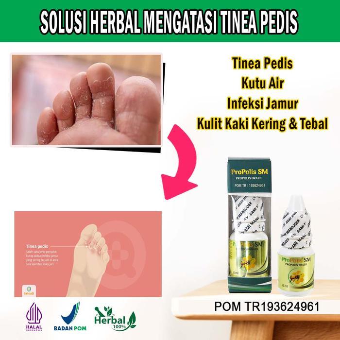 Terlaris Obat Tinea Pedis, Kutu Air, Infeksi Jamur, Kulit Kaki Kering dan Tebal