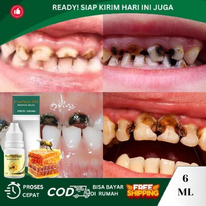 PROMO PERONTOK GIGI RUSAK HITAM BERLUBANG, GIGI RUSAK PADA ANAK, GIGI HITAM, GIGI KEROPOS, HERBAL