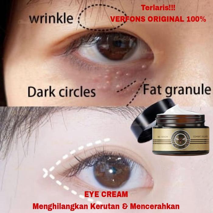 Krim Penghilang Milia Obat Milia Di Bawah Mata Cream Vitamin E Eye Cream Penghilang Milia Syringoma