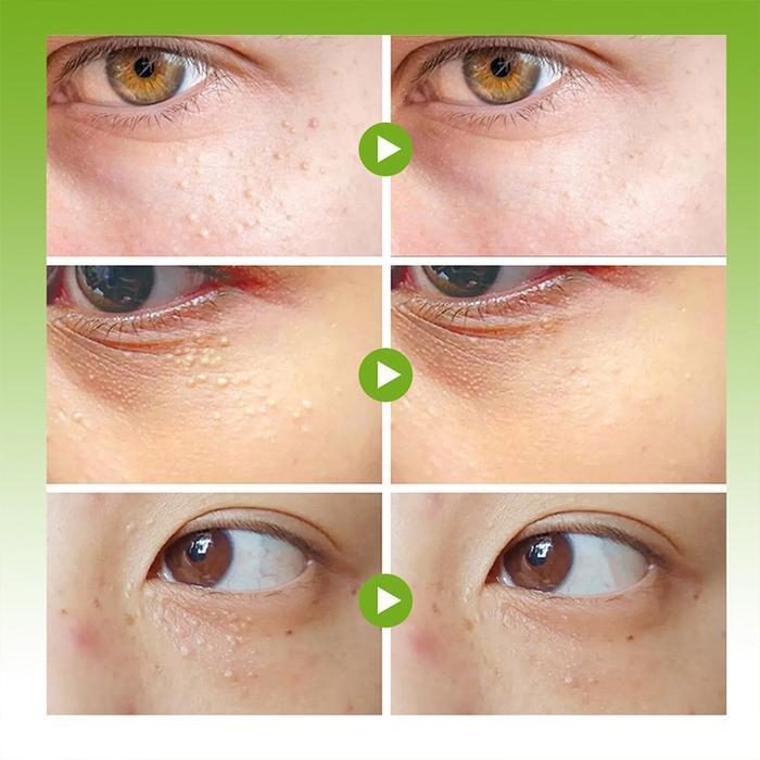 Vitamin penghilang milia syringoma xanthelasma butiran lemak sekitar mata dan menghilangkan kantung
