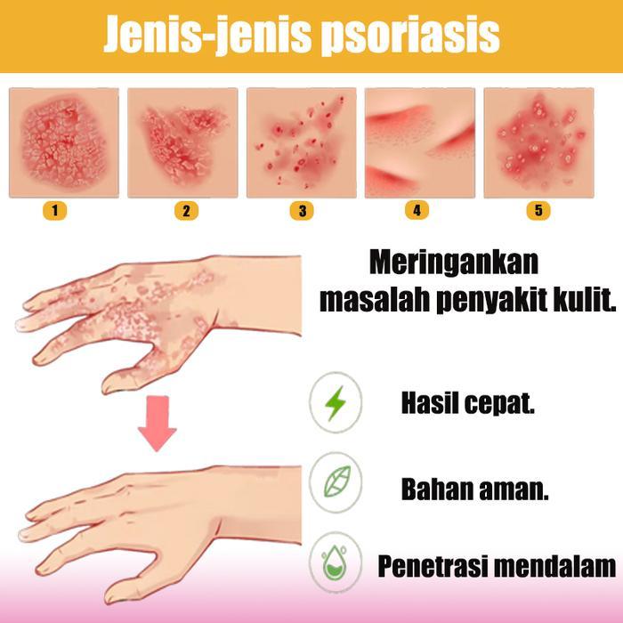 Salap Gatal Kulit Yang Ampuh Salep China Untuk Gatal Gatal Obat Gatal Selangkangan Dan Hitam 20G
