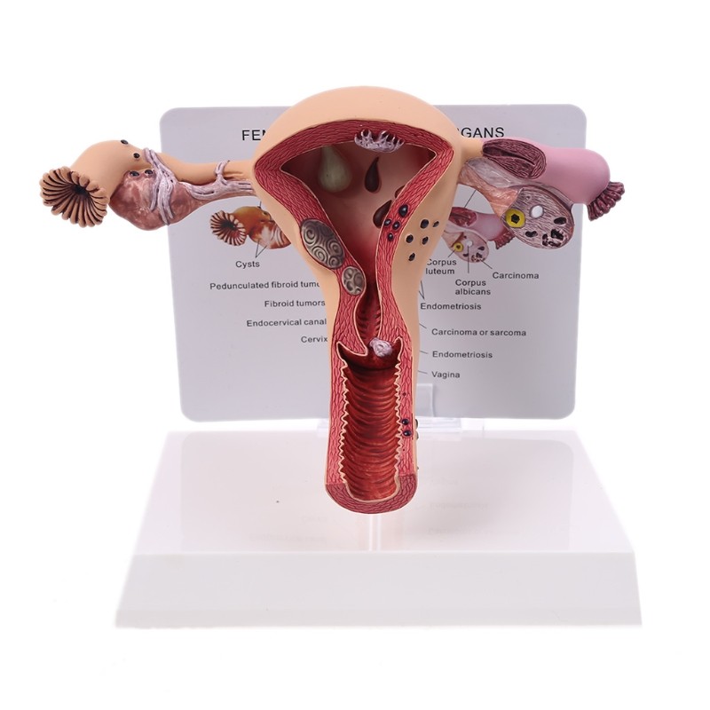 Promo Biology Teaching, Anatomy Lesion Uterus Model, Human Female Uterus Ovary Disease Dissection Pa