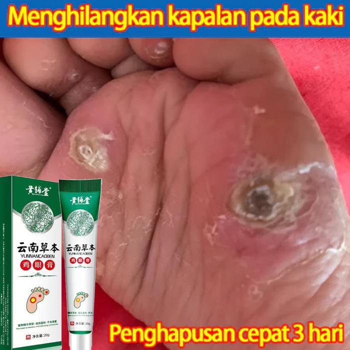 Obat Mata Ikan Pada Telapak Kaki, Perontok Mata Ikan di Telapak Kaki & Tangan, Mata Ikan Di Kaki,