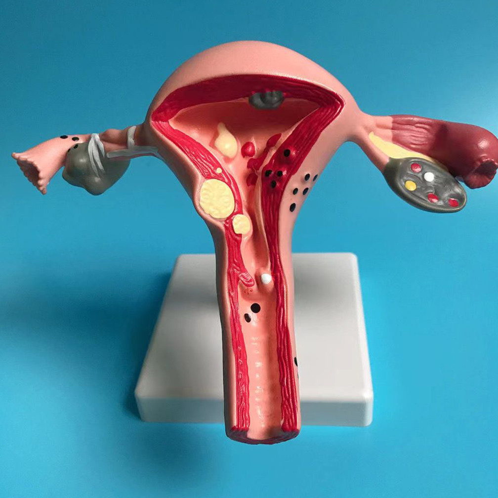 Promo Female Human Uterus Ovary Disease Dissection Pathology Model Biology Teaching Aids Anatomy Les