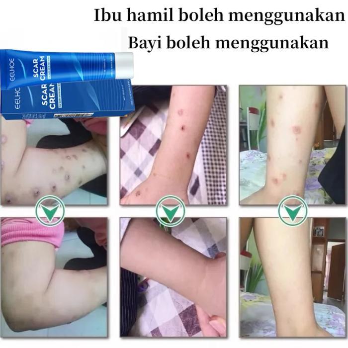 Penghilang bekas koreng hitam Penghilang bekas koreng lama Penghilang Bekas gigitan nyamu Keloid