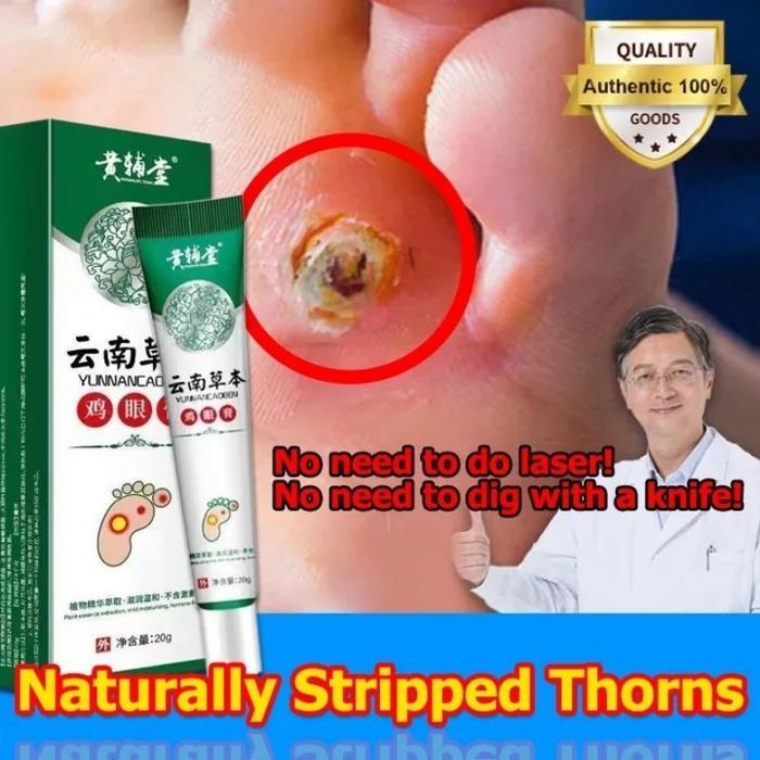 Obat Mata Ikan Pada Telapak Kaki, Perontok Mata Ikan di Telapak Kaki & Tangan, Mata Ikan Di Kaki,