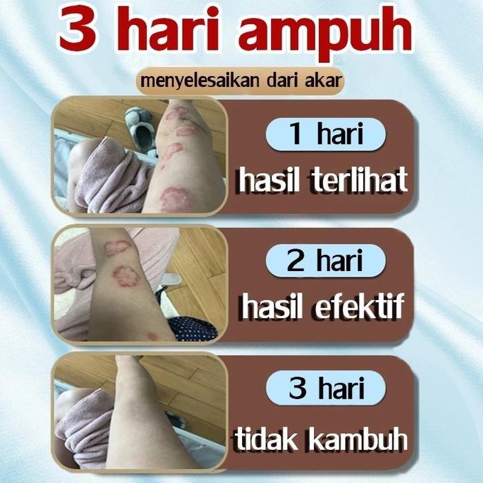 Salep Gatal Paling Ampuh Obat Salep Psoriasis Gatal Kulit Salep Alergi Kulit Gatal Salep Eksim Jamur