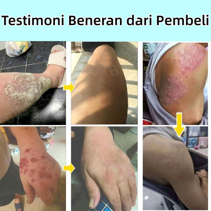 Salep gatal selangkangan Saleb gatal paling ampuh Menghilangkan eksim dan Kurap Anti jamur