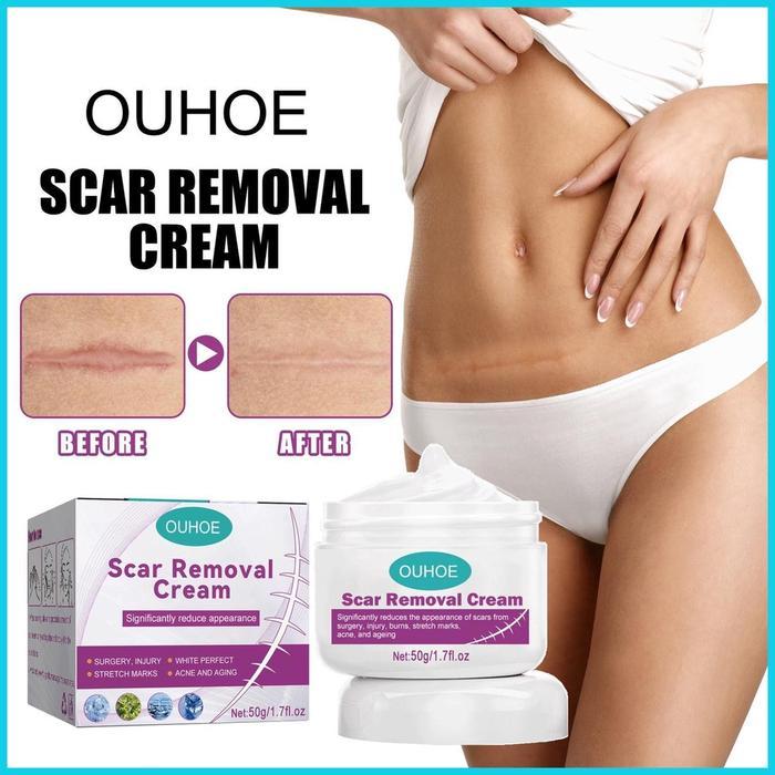 Scar Remover Cream Penghilang Bekas Luka Salep Penghilang bekas luka Penghilang luka koreng bekas