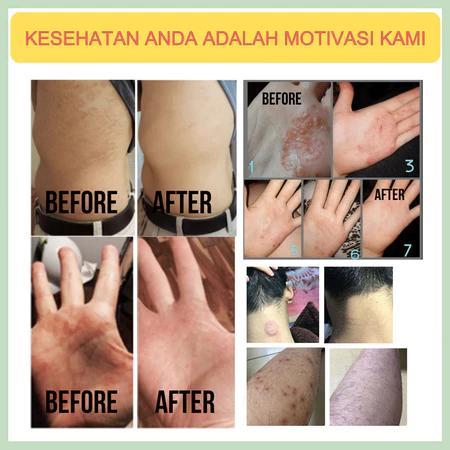 Psoriasis Salep Psoriasis Obat Kurap Obat Kurap Paling Ampuh Salep Gatal Paling Ampuh 20G