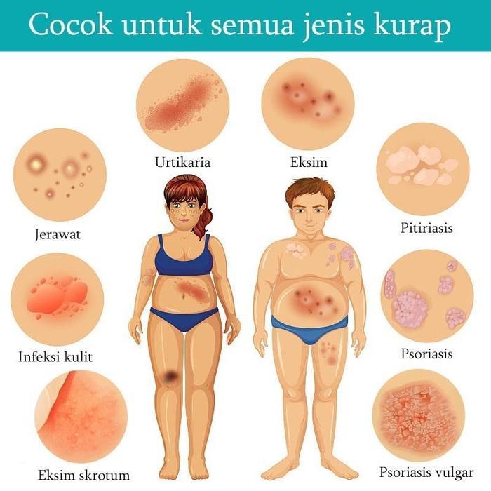 salep gatal paling ampuh salep eksim cream eksim psoriasis cream ori salep eksim kering salep gatal