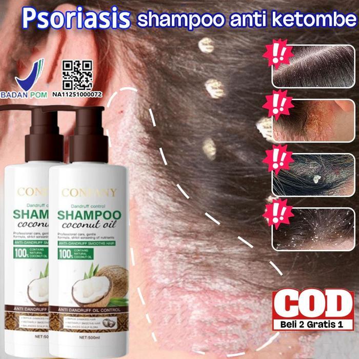 Shampoo Anti Ketombe Dan Gatal Penghilang Ketombe Shampo Psoriasis Kulit Kepala Obat Ketombe