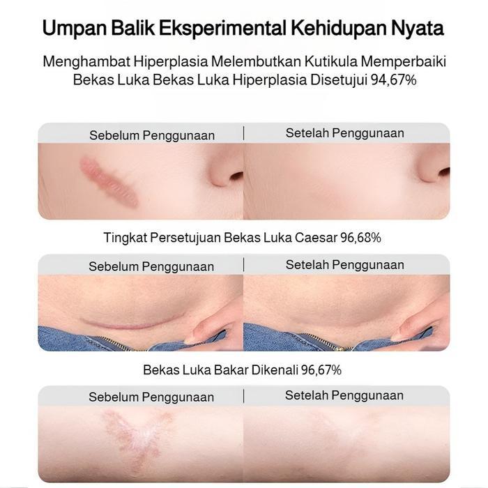 Scar Formula Cream Salep Penghilang Bekas Luka / Keloid ANTI SCAR Cream Krim Digigit Serangga Nyamuk