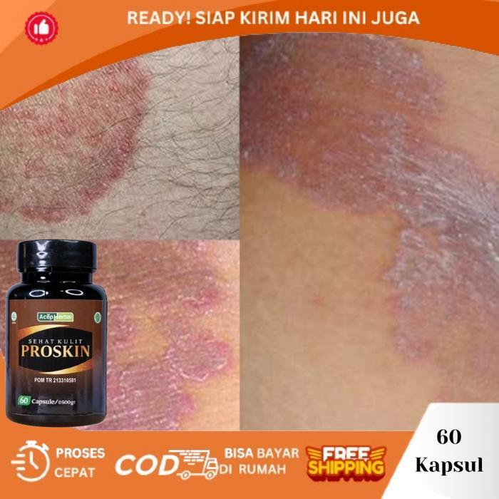 Lariss Maniss Penghilang Selangkangan Hitam, Selangkangan Berjamur, Gatal Selangkangan Pria Wanita,