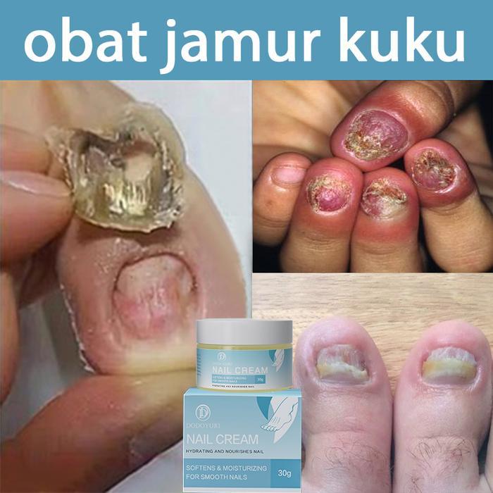 BPOMObat kuku obat jamur kuku obat cantengan obat kuku rusak dan jamur 30ml obat kuku jamur dan