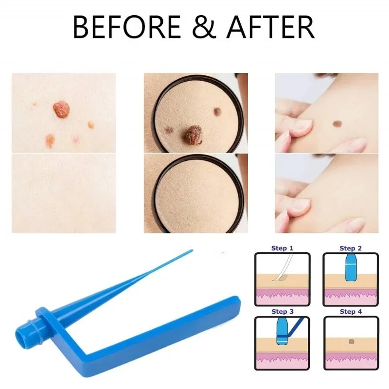 Skin Care Rubber Bands Skin Tag Remover Skin Tag Removal Kit Face Care Mole Wart Tool Skincare Green