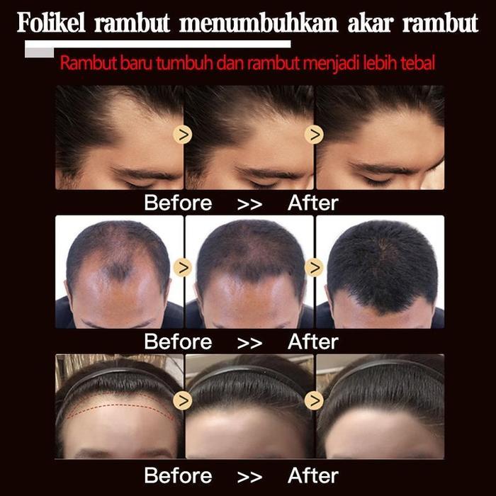 [Ready Stock]Obat Alopecia Areata, Menumbuhkan Penumbuh Rambut Cepat Obat, Penumbuh Rambut Botak