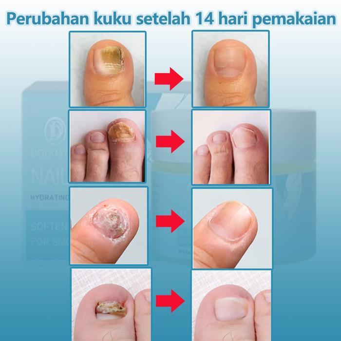 Obat jamur kuku Obat kuku Obat cantengan Obat kuku rusak dan jamur 30g obt cantengan jempol kaki