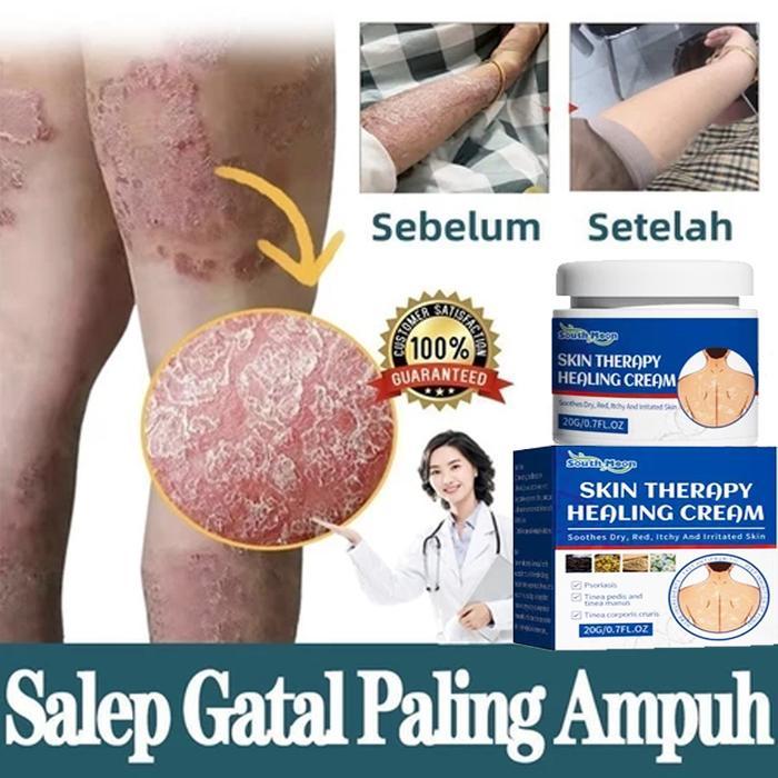 Psoriasis Salep psoriasis Obat kurap Obat kurap paling ampuh Salep gatal paling ampuh 20g