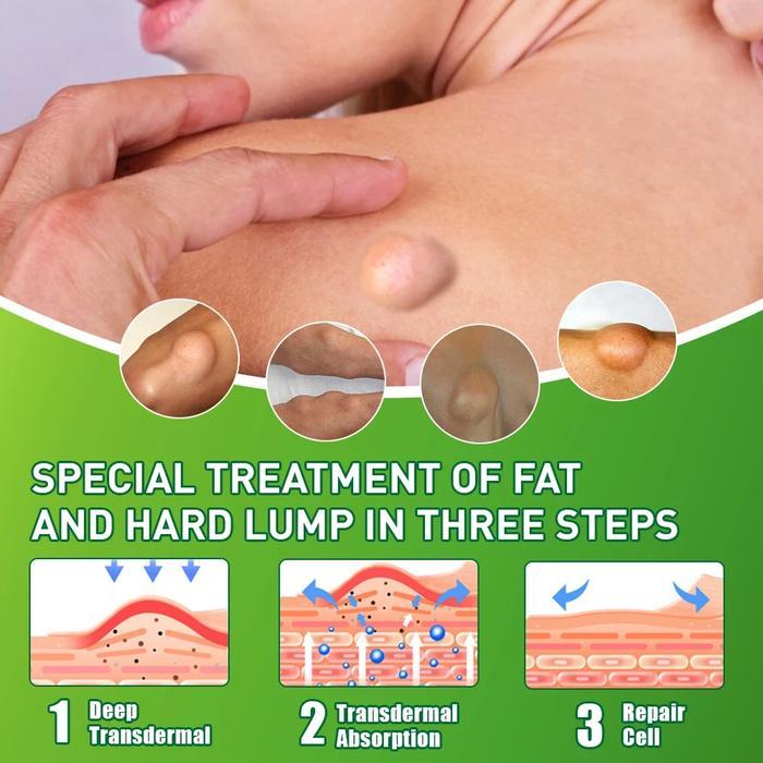 Obat Benjolan Lipoma 20g Salep lipoma cream salep benjolan 100% lipoma krim original Salep Benjolan