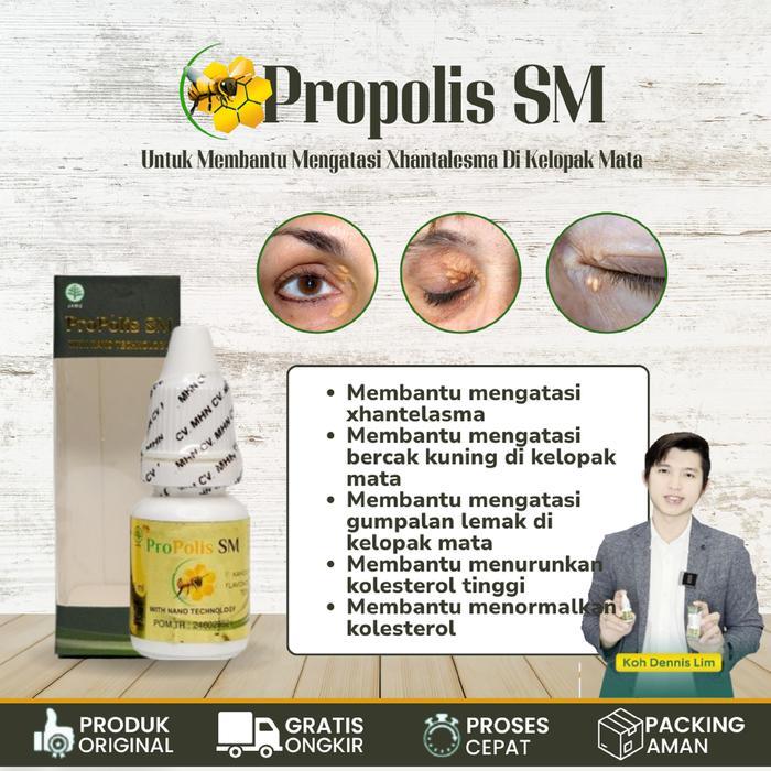 Propolis Sm Cairan Penghilang Bercak Kuning Xanthelasma Kelopak Mata Propolis Sm Eye Lens Obat