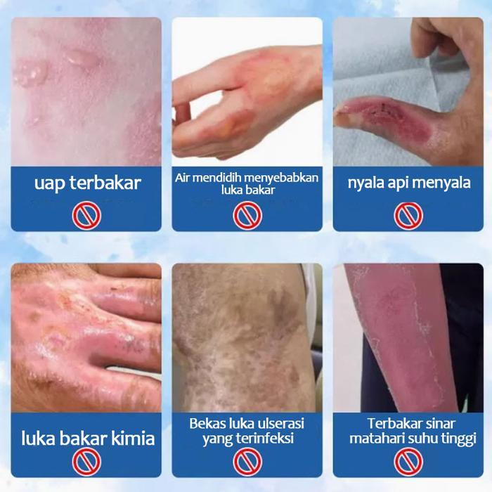 Salep Luka Bakar Paling Ampuh Obat Luka Bakar Salep Bekas Luka Bakar Penghilang Bekas Luka Bakar