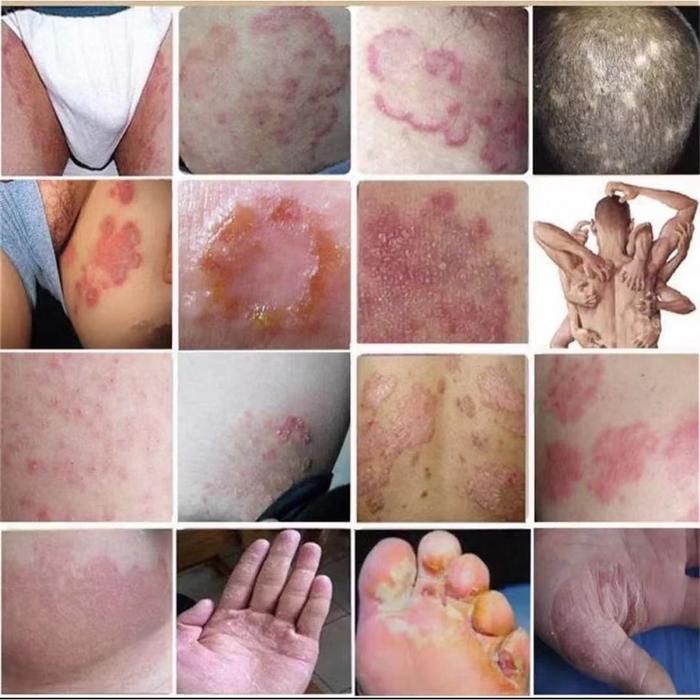 Salep Gatal Paling Ampuh Obat Gatal Kulit Eczema Cream Untuk Orang Yang Tua Dan Anak Untuk Seluruh