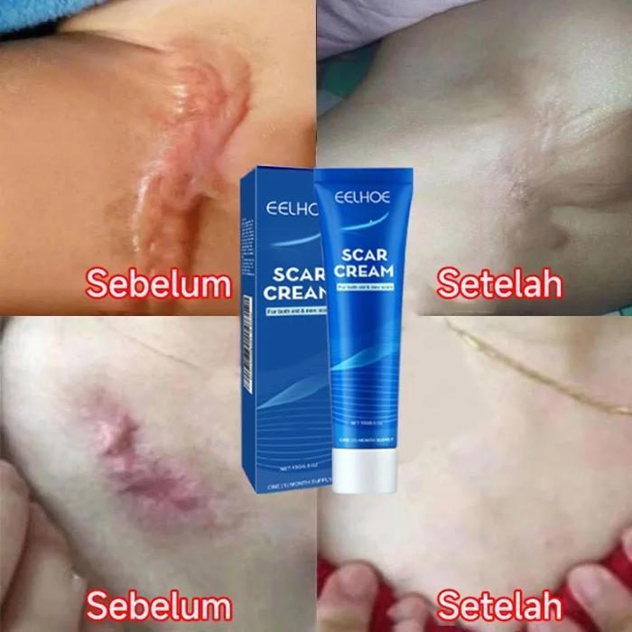 Salep penghilang bekas luka Penghilang bekas luka hitam koreng Penghilang bekas luka di kaki