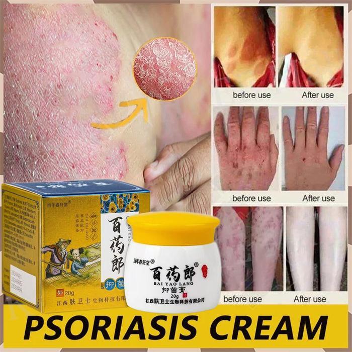 Salep gatal china paling ampuh salep gatal jamur selangkanga Krim Eksim Bayi dan Anak Obat gatal sel