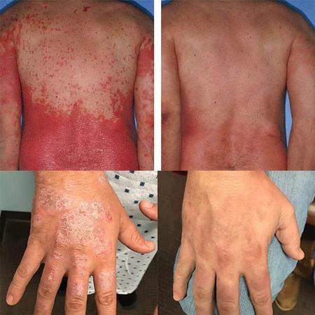 Psoriasis Salep psoriasis Obat kurap Obat kurap paling ampuh Salep gatal paling ampuh 20g