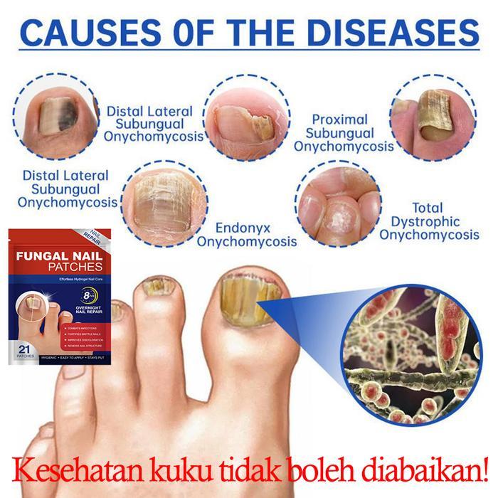 Obat Jamur Kuku Fungal Nail Patches Obat Cantengan Obat Kuku Rusak Pembersih Kuku Kaki Hitam Fungal