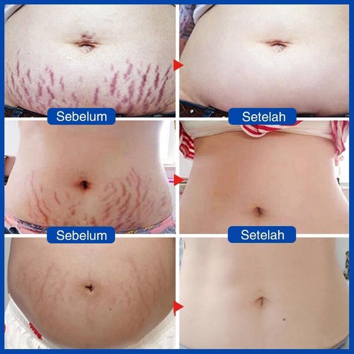 Stretch Mark Cream Stretch Mark Paling Ampuh 30Ml Rintik Stretch Mark Cream Krim Perawatan
