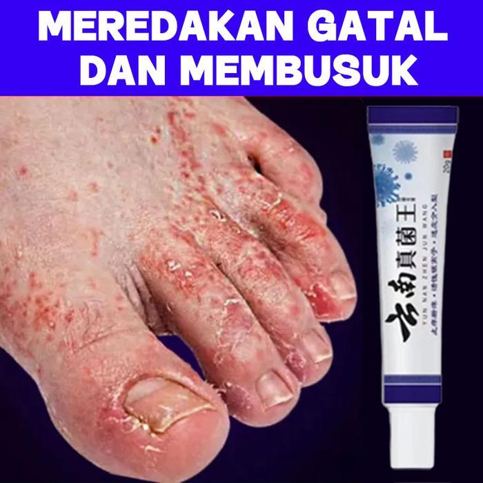Krim Perawatan Anti Bakteri , Menghilangkan Jamur Tinea Pedis Salep Perawatan Kaki Ready