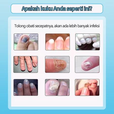 Krim perbaikan kuku, salep antijamur kuku, jamur kuku kaki, infeksi jamur kuku tangan, kuku tumbuh
