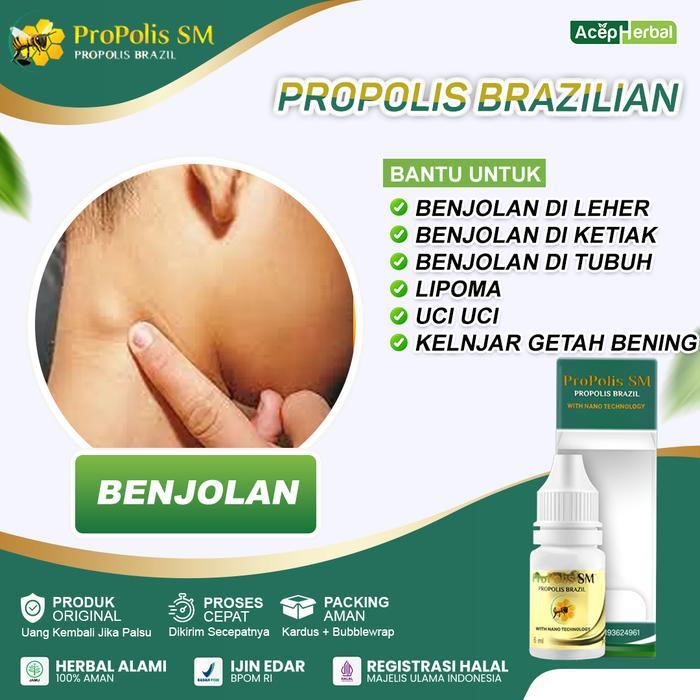 ish8- Propolis Sm Untuk Benjolan Leher Badan Tangan Gondok Kelenjar Getah Bening Ganglion
