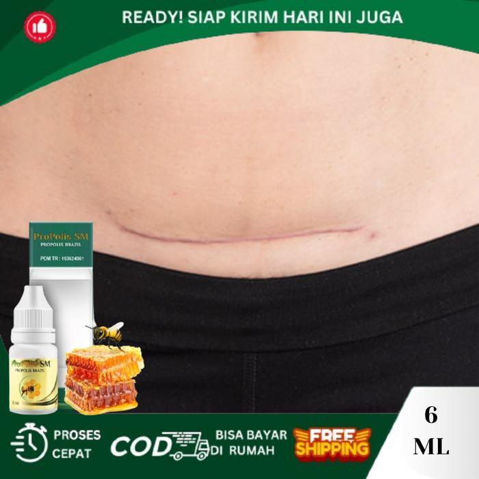 Penghilang Luka Bekas Operasi, Penghilang Bekas Luka Jahitan -Gratisongkir