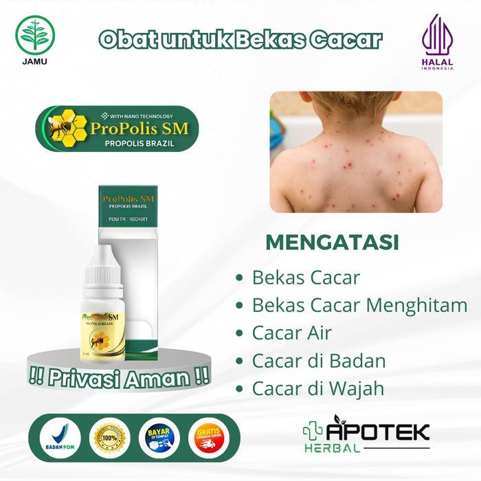 Propolis Sm Atasi Bekas Cacar, Berlubang, Bekas Cacar Menghitam, Cacar Air Anak, Obat Cacar Di Badan