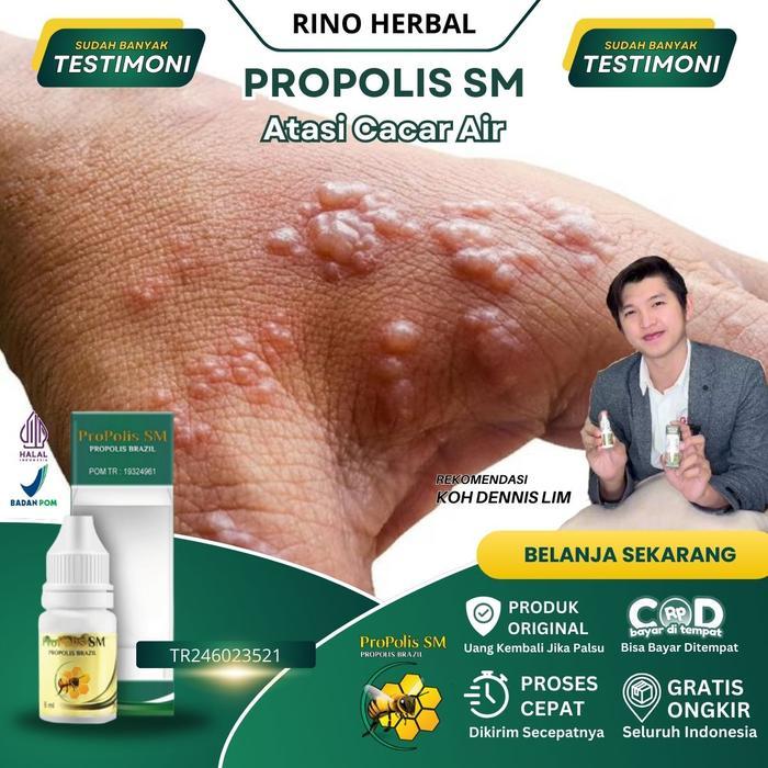 Obat Cacar Air & Bekas Cacar, Obat Herpes Zoster, Obat Gatal Berair, Salep Cacar Air, Obat Cacar Api