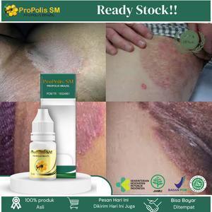 Propolis Sm Untuk Gatal Selangkangan, Selangkangan Hitam Dan Gatal, Pemutih Selangkangan Hitam,