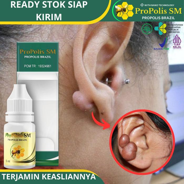 Propolis Sm - Untuk Luka Keloid Menonjol Bekas Tindik, Bekas Luka Operasi Dan Luka Jatuh